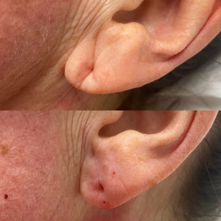 Før og efter ear filler